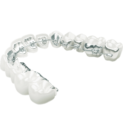 lingual braces